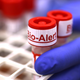 A swab specimen containing monkeypox virus is labeled ‘Bio Alert’ at the UW Medicine Virology Laboratory on July 12, 2022 in Seattle, Washington.